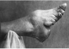 Footbinding |A foot which has been deformed by binding|